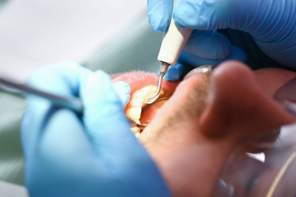 Urgent Tooth Repair in FL